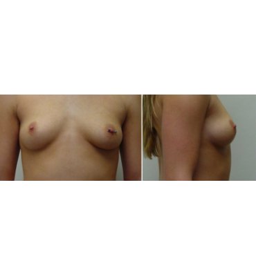 Breast Implants & Body Piercing Before